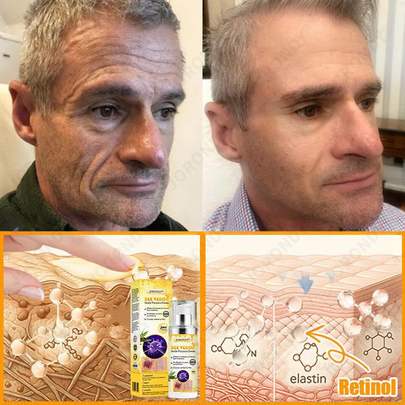 𝐎𝐅𝐅𝐈𝐂𝐈𝐀𝐋 𝐒𝐓𝐎𝐑𝐄!🐝 JORONDY® Bee Venom Senile Purpura Cream: The FDA-Registered Skincare Solution for Age-Related Skin Frailness.