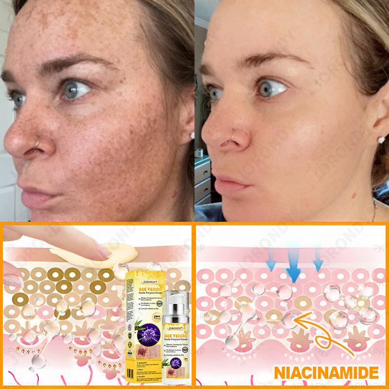 𝐎𝐅𝐅𝐈𝐂𝐈𝐀𝐋 𝐒𝐓𝐎𝐑𝐄!🐝 JORONDY® Bee Venom Senile Purpura Cream: The FDA-Registered Skincare Solution for Age-Related Skin Frailness.