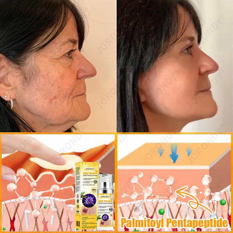 𝐎𝐅𝐅𝐈𝐂𝐈𝐀𝐋 𝐒𝐓𝐎𝐑𝐄!🐝 JORONDY® Bee Venom Senile Purpura Cream: The FDA-Registered Skincare Solution for Age-Related Skin Frailness.
