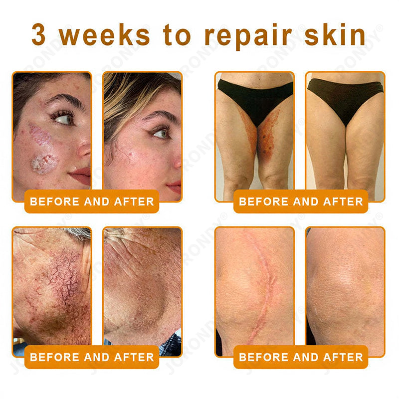𝐎𝐅𝐅𝐈𝐂𝐈𝐀𝐋 𝐒𝐓𝐎𝐑𝐄!🐝 JORONDY® Bee Venom Senile Purpura Cream: The FDA-Registered Skincare Solution for Age-Related Skin Frailness.