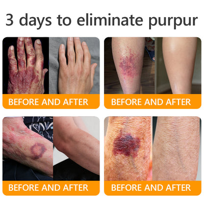 𝐎𝐅𝐅𝐈𝐂𝐈𝐀𝐋 𝐒𝐓𝐎𝐑𝐄!🐝 JORONDY® Bee Venom Senile Purpura Cream: The FDA-Registered Skincare Solution for Age-Related Skin Frailness.