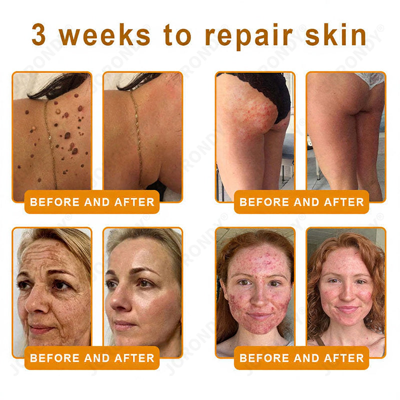 𝐎𝐅𝐅𝐈𝐂𝐈𝐀𝐋 𝐒𝐓𝐎𝐑𝐄!🐝 JORONDY® Bee Venom Senile Purpura Cream: The FDA-Registered Skincare Solution for Age-Related Skin Frailness.