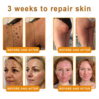𝐎𝐅𝐅𝐈𝐂𝐈𝐀𝐋 𝐒𝐓𝐎𝐑𝐄!🐝 JORONDY® Bee Venom Senile Purpura Cream: The FDA-Registered Skincare Solution for Age-Related Skin Frailness.