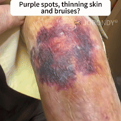 𝐎𝐅𝐅𝐈𝐂𝐈𝐀𝐋 𝐒𝐓𝐎𝐑𝐄!🐝 JORONDY® Bee Venom Senile Purpura Cream: The FDA-Registered Skincare Solution for Age-Related Skin Frailness.